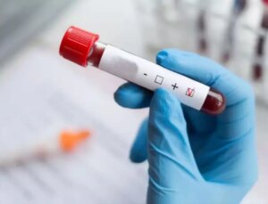 Dünyada vakalar azalıyor, Türkiye’de ise HIV artıyor