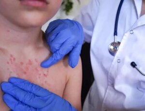 Vakalar pik yaptı! İki haftada ortaya çıkıyor, 3 yıl kadar sürüyor